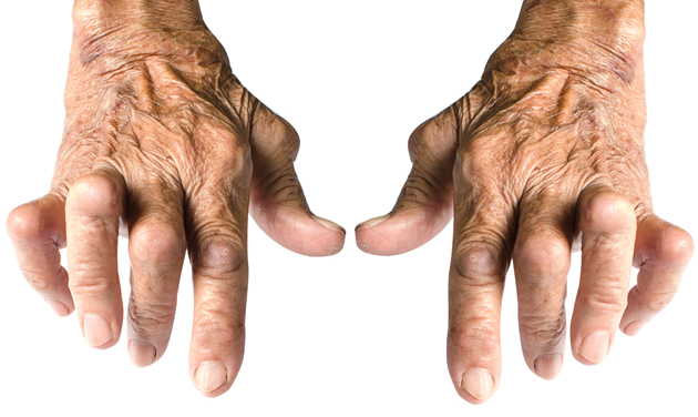 Mão Reumatóide